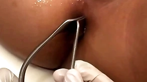 Asian patient penetrated in anal crevice by stud in gospeller